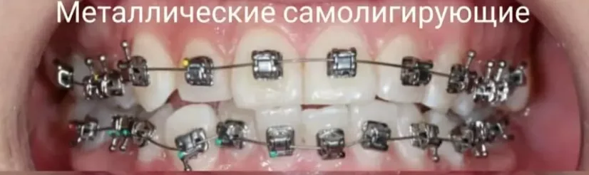 Металлические самолигирующие брекеты на верхних и нижних зубах