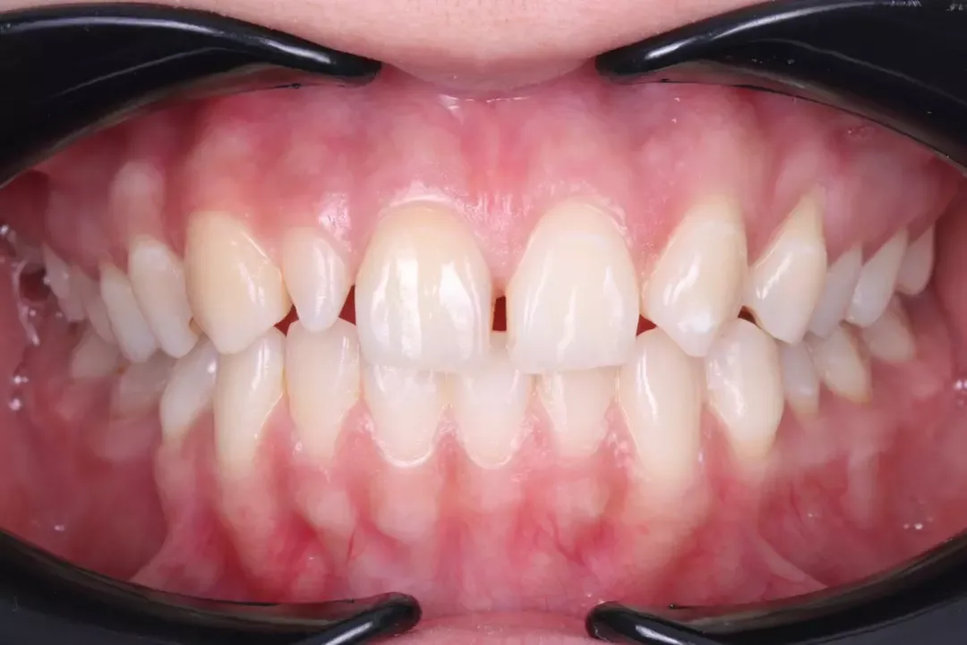 Зубы пациента до установки брекетов, вид спереди
